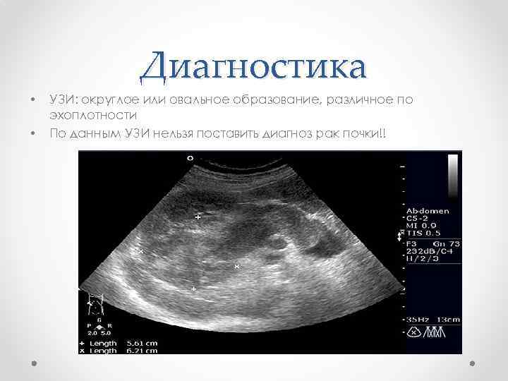 Диагностика • • УЗИ: округлое или овальное образование, различное по эхоплотности По данным УЗИ