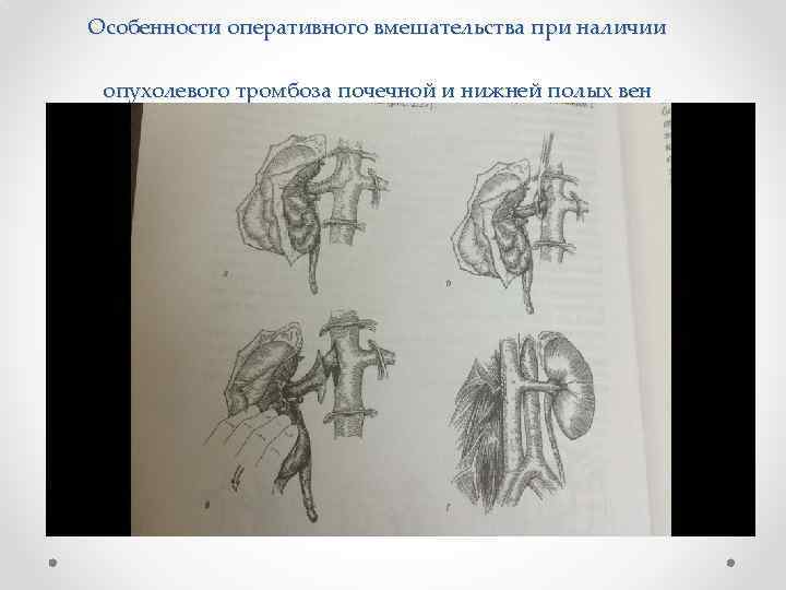 Особенности оперативного вмешательства при наличии опухолевого тромбоза почечной и нижней полых вен 