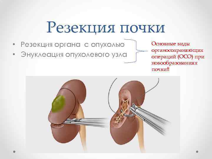 Резекция почки • Резекция органа с опухолью • Энуклеация опухолевого узла Основные виды органосохраняющих