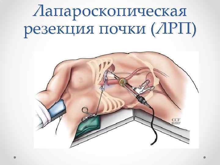 Лапароскопическая резекция почки (ЛРП) 