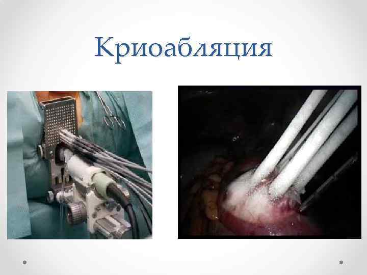 Криоабляция 