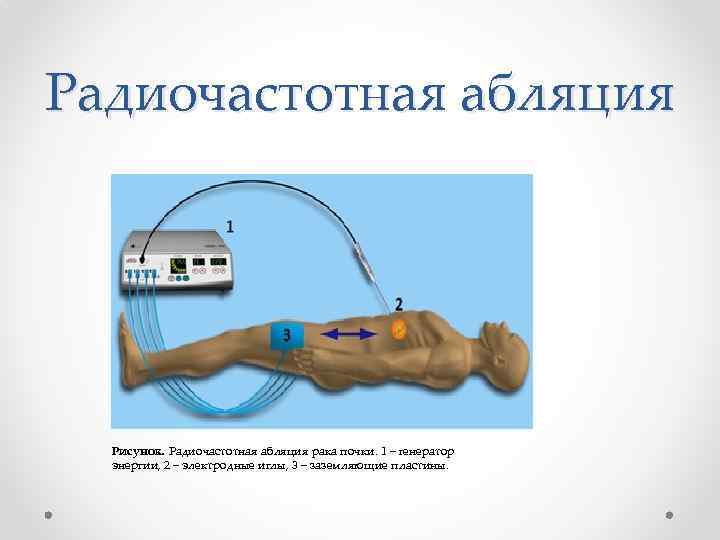 Радиочастотная абляция Рисунок. Радиочастотная абляция рака почки. 1 – генератор энергии, 2 – электродные