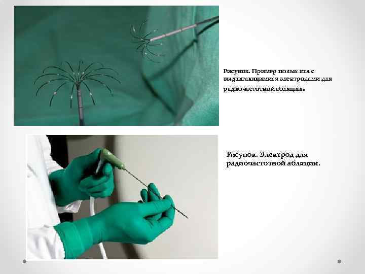 Рисунок. Пример полых игл с выдвигающимися электродами для радиочастотной абляции. Рисунок. Электрод для радиочастотной