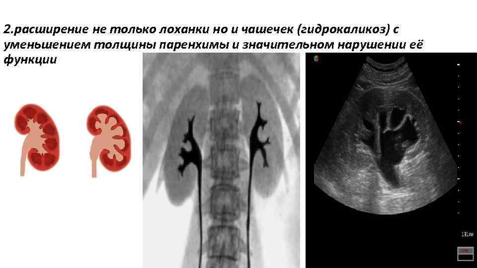 Лоханка почки расширена лечение