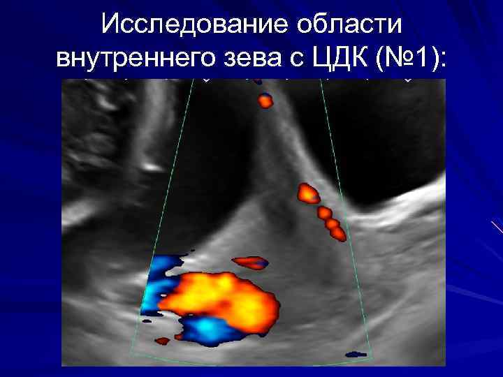 Исследование области внутреннего зева с ЦДК (№ 1): 