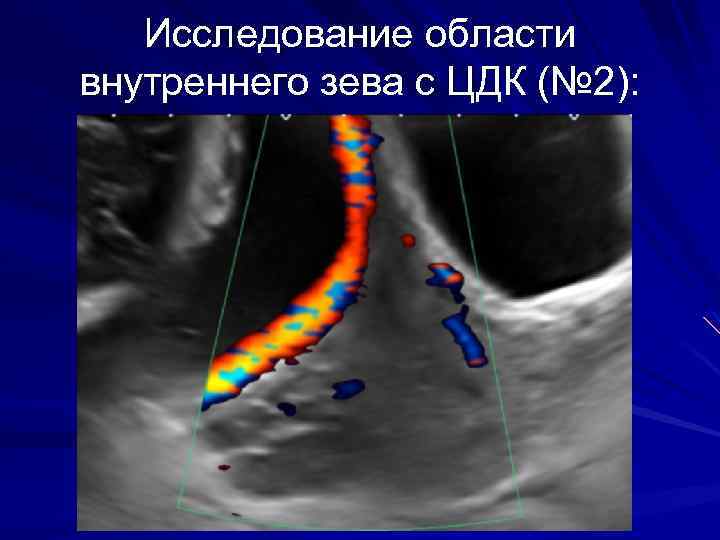 Исследование области внутреннего зева с ЦДК (№ 2): 