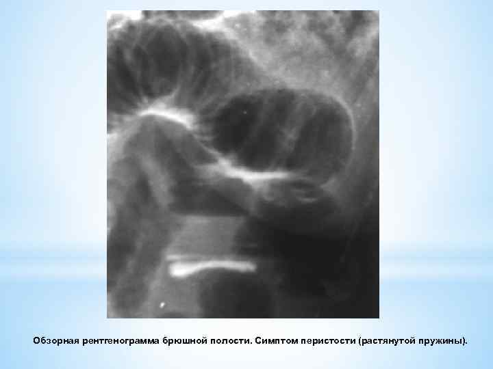 Обзорная рентгенограмма брюшной полости. Симптом перистости (растянутой пружины). 