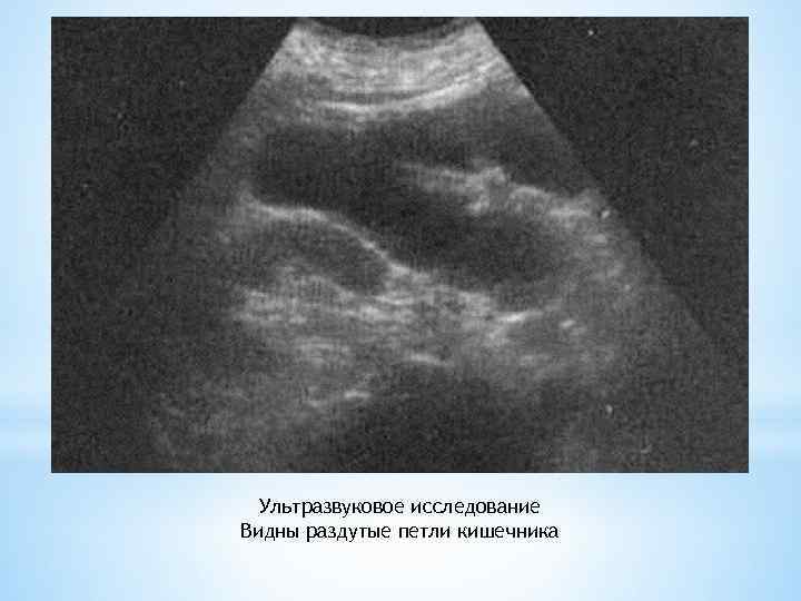 Ультразвуковое исследование Видны раздутые петли кишечника 