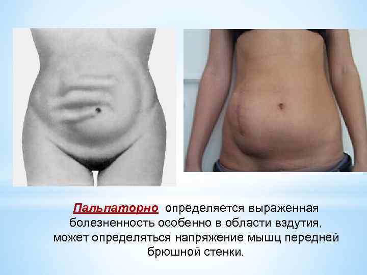 Пальпаторно определяется выраженная болезненность особенно в области вздутия, может определяться напряжение мышц передней брюшной