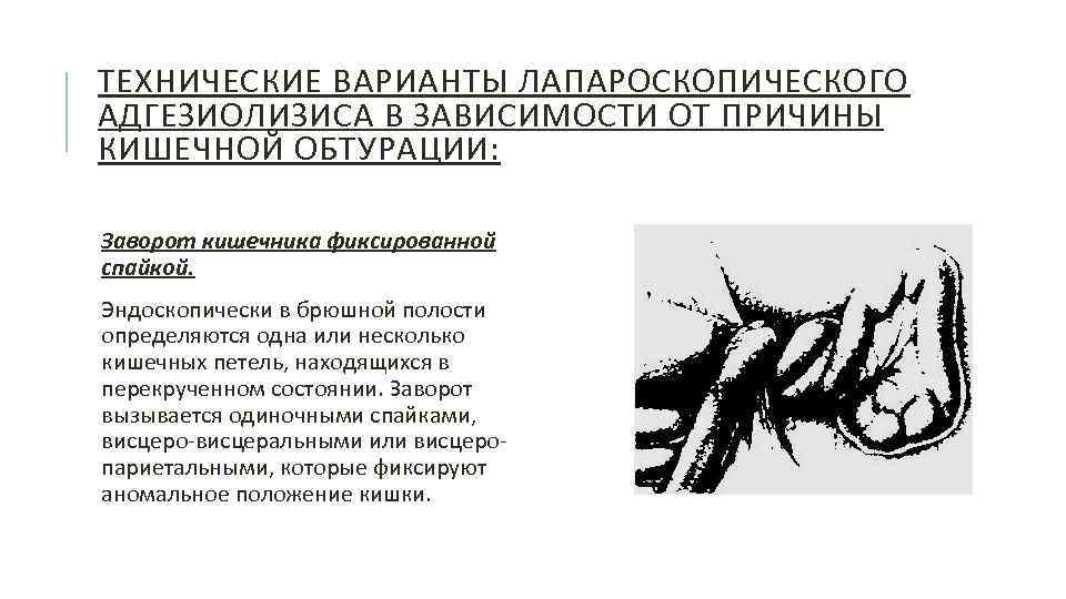 ТЕХНИЧЕСКИЕ ВАРИАНТЫ ЛАПАРОСКОПИЧЕСКОГО АДГЕЗИОЛИЗИСА В ЗАВИСИМОСТИ ОТ ПРИЧИНЫ КИШЕЧНОЙ ОБТУРАЦИИ: Заворот кишечника фиксированной спайкой.