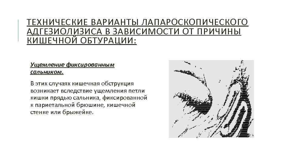ТЕХНИЧЕСКИЕ ВАРИАНТЫ ЛАПАРОСКОПИЧЕСКОГО АДГЕЗИОЛИЗИСА В ЗАВИСИМОСТИ ОТ ПРИЧИНЫ КИШЕЧНОЙ ОБТУРАЦИИ: Ущемление фиксированным сальником. В