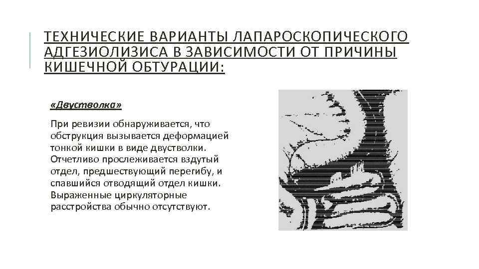 ТЕХНИЧЕСКИЕ ВАРИАНТЫ ЛАПАРОСКОПИЧЕСКОГО АДГЕЗИОЛИЗИСА В ЗАВИСИМОСТИ ОТ ПРИЧИНЫ КИШЕЧНОЙ ОБТУРАЦИИ: «Двустволка» При ревизии обнаруживается,