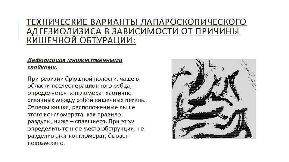 ТЕХНИЧЕСКИЕ ВАРИАНТЫ ЛАПАРОСКОПИЧЕСКОГО АДГЕЗИОЛИЗИСА В ЗАВИСИМОСТИ ОТ ПРИЧИНЫ КИШЕЧНОЙ ОБТУРАЦИИ: Деформация множественными спайками. При
