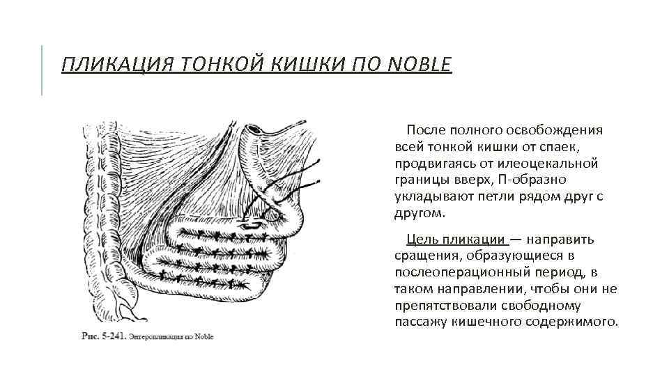 ПЛИКАЦИЯ ТОНКОЙ КИШКИ ПО NOBLE После полного освобождения всей тонкой кишки от спаек, продвигаясь