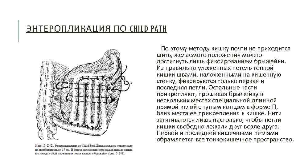 ЭНТЕРОПЛИКАЦИЯ ПО CHILD PATH По этому методу кишку почти не приходится шить, желаемого положения
