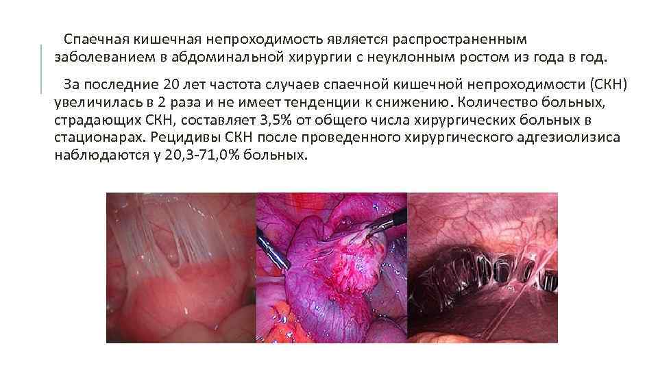 Спаечная кишечная непроходимость является распространенным заболеванием в абдоминальной хирургии с неуклонным ростом из года