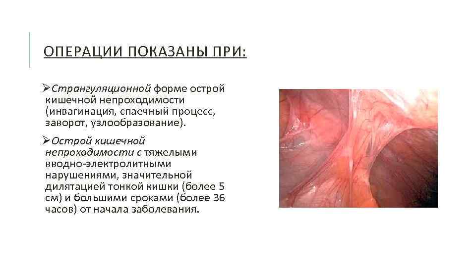 ОПЕРАЦИИ ПОКАЗАНЫ ПРИ: ØСтрангуляционной форме острой кишечной непроходимости (инвагинация, спаечный процесс, заворот, узлообразование). ØОстрой