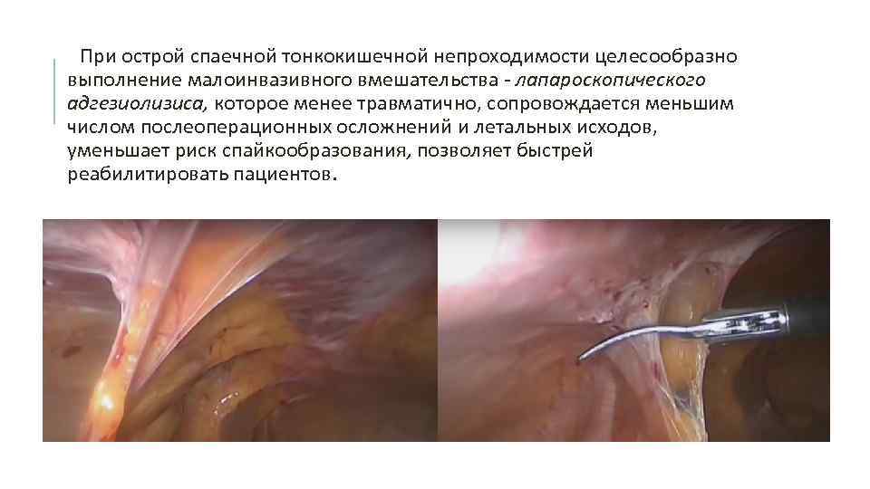 При острой спаечной тонкокишечной непроходимости целесообразно выполнение малоинвазивного вмешательства - лапароскопического адгезиолизиса, которое менее