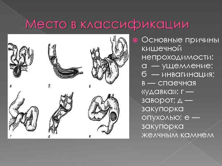 Место в классификации Основные причины кишечной непроходимости: а — ущемление; б — инвагинация; в