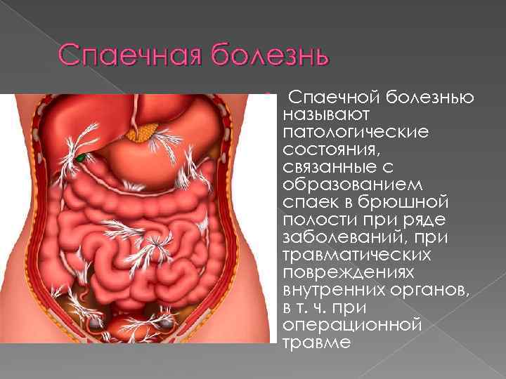 Спаечная болезнь Спаечной болезнью называют патологические состояния, связанные с образованием спаек в брюшной полости