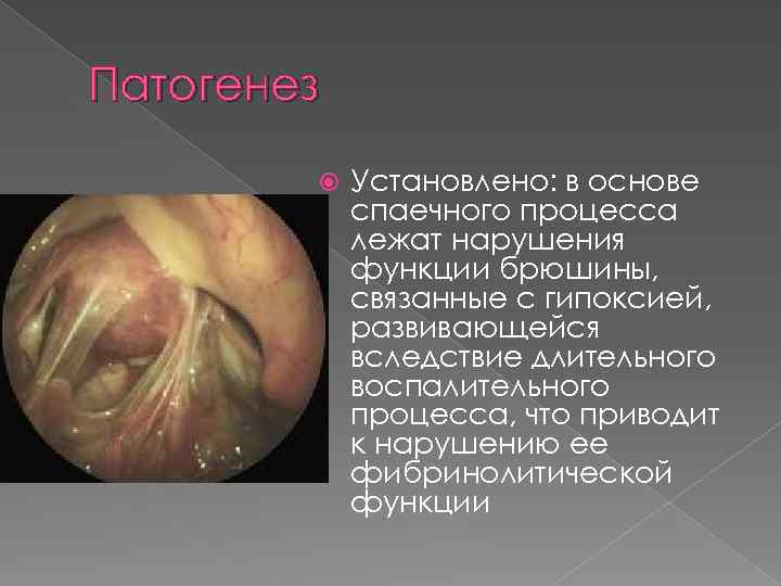 Патогенез Установлено: в основе спаечного процесса лежат нарушения функции брюшины, связанные с гипоксией, развивающейся