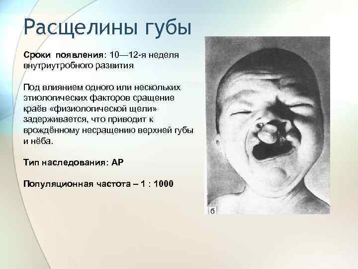 Расщелины губы Сроки появления: 10— 12 я неделя внутриутробного развития Под влиянием одного или