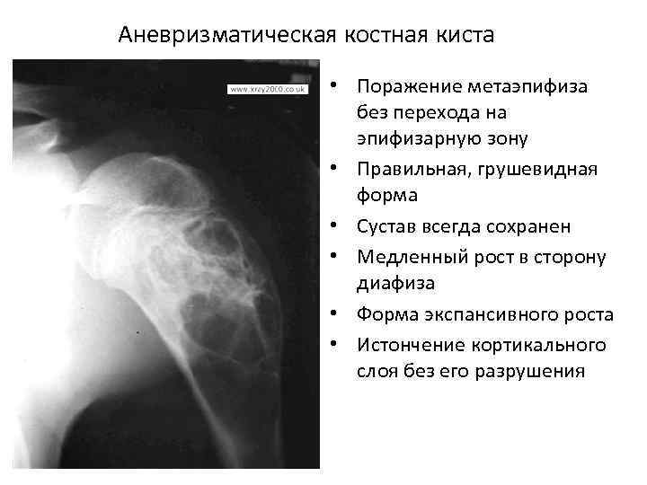 Аневризматическая костная киста • Поражение метаэпифиза без перехода на эпифизарную зону • Правильная, грушевидная