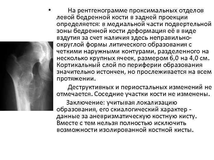 На рентгенограмме проксимальных отделов левой бедренной кости в задней проекции определяется: в медиальной части