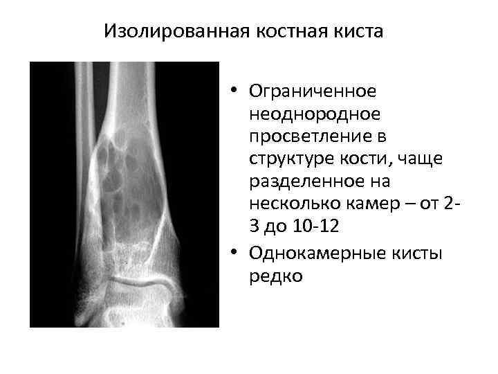 Изолированная костная киста • Ограниченное неоднородное просветление в структуре кости, чаще разделенное на несколько