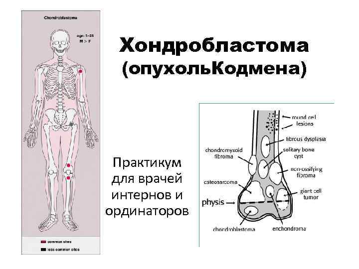 Хондробластома (опухоль. Кодмена) Практикум для врачей интернов и ординаторов 