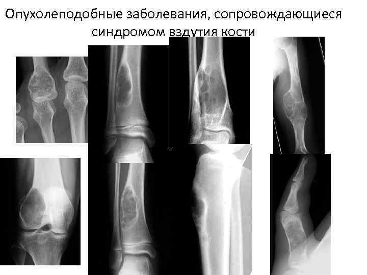 Хондробластома. Хондробластома бедренной кости.