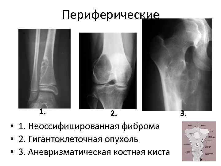 Периферические 1. 2. • 1. Неоссифицированная фиброма • 2. Гигантоклеточная опухоль • 3. Аневризматическая