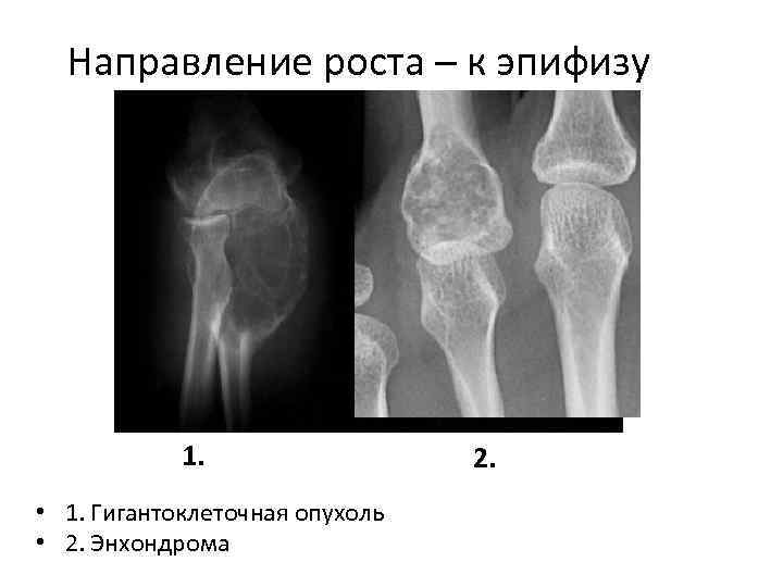 Направление роста – к эпифизу 1. • 1. Гигантоклеточная опухоль • 2. Энхондрома 2.