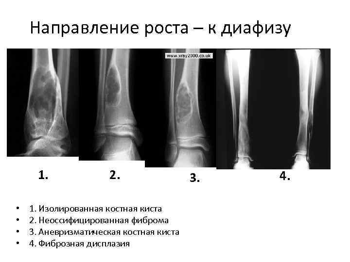 Направление роста – к диафизу 1. • • 2. 1. Изолированная костная киста 2.