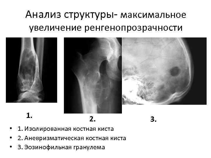 Максимальное увеличение. Аневризматическая костная киста кт черепа. Изолированная костная киста. Аневризматическая костная киста рентген. Аневризматическая киста ребра.