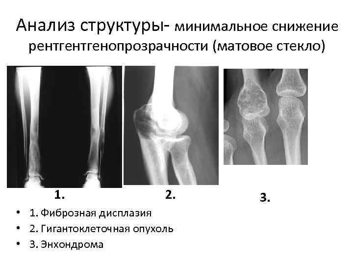 Анализ структуры- минимальное снижение рентгенопрозрачности (матовое стекло) 1. 2. • 1. Фиброзная дисплазия •