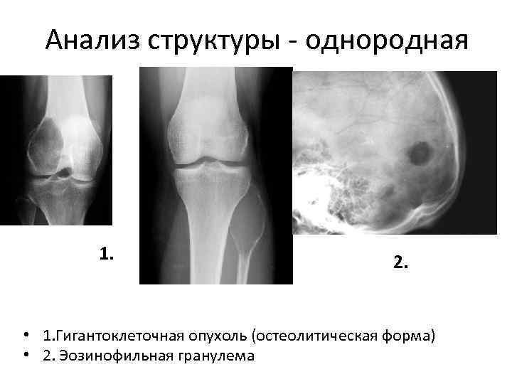 Анализ структуры - однородная 1. 2. • 1. Гигантоклеточная опухоль (остеолитическая форма) • 2.