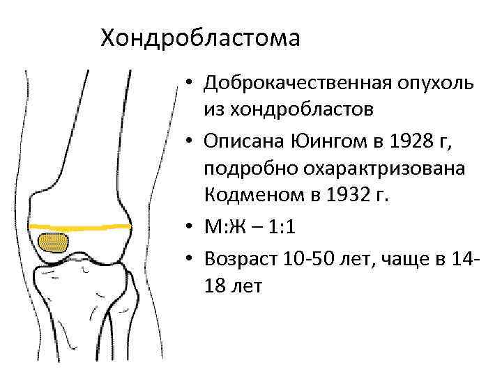 Хондробластома • Доброкачественная опухоль из хондробластов • Описана Юингом в 1928 г, подробно охарактризована