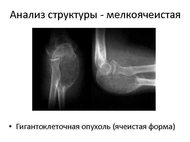 Анализ структуры - мелкоячеистая • Гигантоклеточная опухоль (ячеистая форма) 