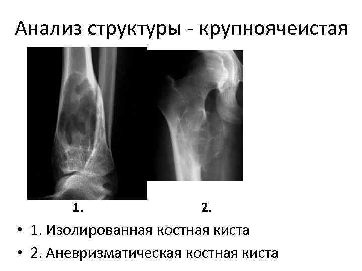 Анализ структуры - крупноячеистая 1. 2. • 1. Изолированная костная киста • 2. Аневризматическая