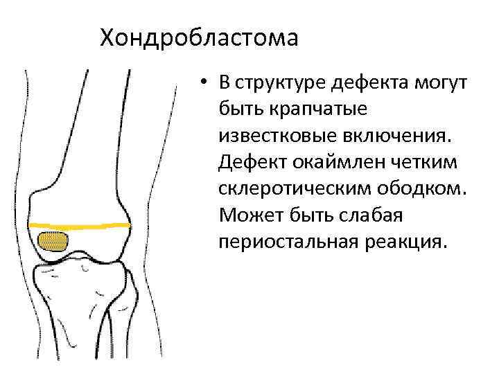 Хондробластома • В структуре дефекта могут быть крапчатые известковые включения. Дефект окаймлен четким склеротическим