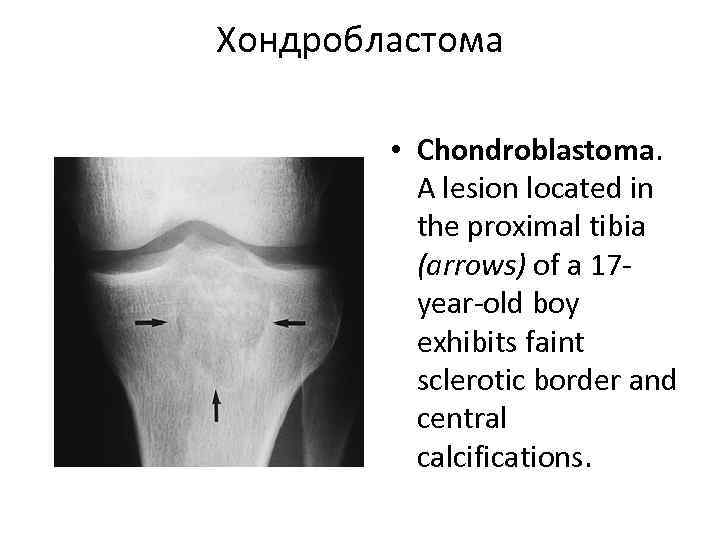 Хондробластома • Chondroblastoma. A lesion located in the proximal tibia (arrows) of a 17