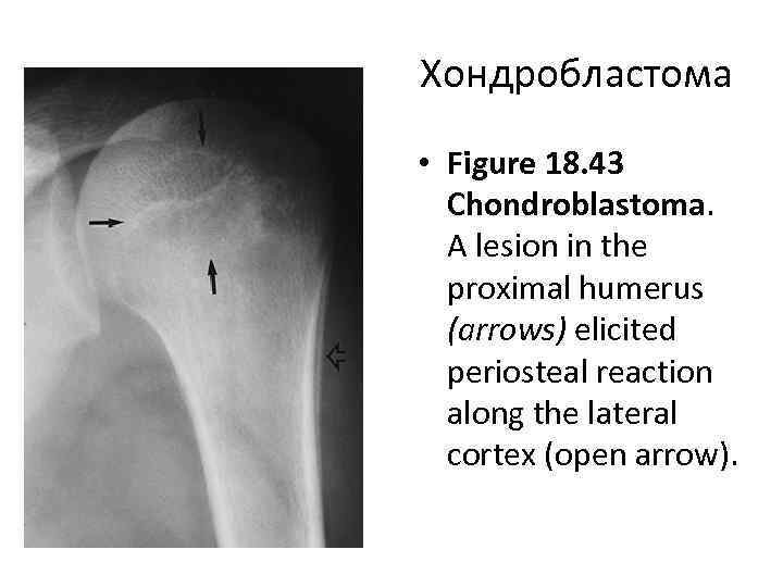 Хондробластома • Figure 18. 43 Chondroblastoma. A lesion in the proximal humerus (arrows) elicited