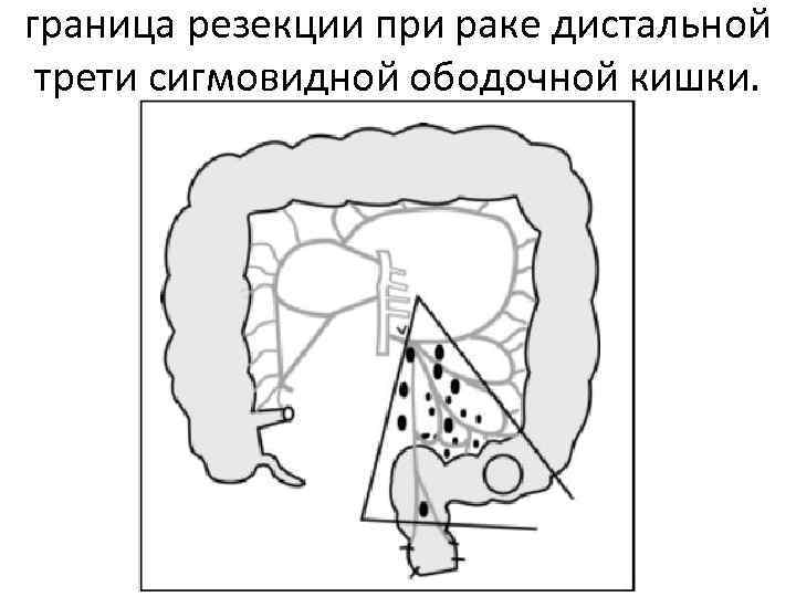 граница резекции при раке дистальной трети сигмовидной ободочной кишки. 