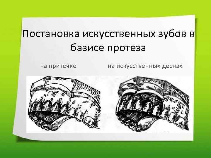 Постановка искусственных зубов в базисе протеза на приточке на искусственных деснах 