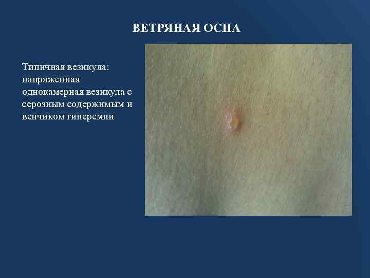 ВЕТРЯНАЯ ОСПА Типичная везикула: напряженная однокамерная везикула с серозным содержимым и венчиком гиперемии 
