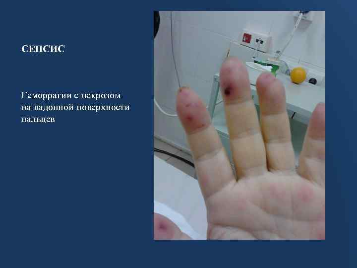 СЕПСИС Геморрагии с некрозом на ладонной поверхности пальцев 