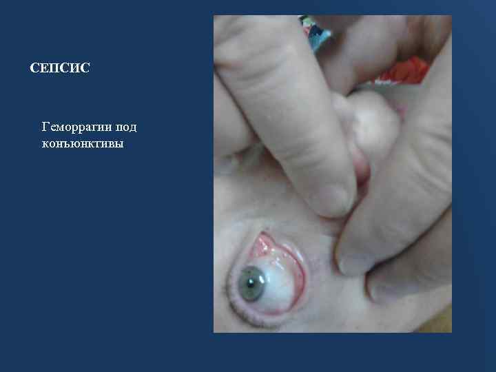 СЕПСИС Геморрагии под конъюнктивы 