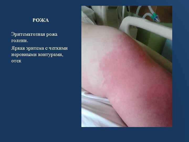 РОЖА Эритематозная рожа голени. Яркая эритема с четкими неровными контурами, отек 