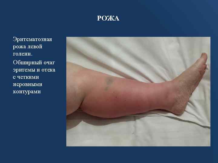 РОЖА Эритематозная рожа левой голени. Обширный очаг эритемы и отека с четкими неровными контурами
